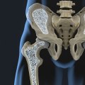 Understanding Medical Treatments for Bone Loss and Fractures