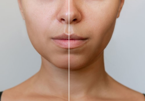Cheekbone Reduction for a More Refined Appearance - A Comprehensive Guide